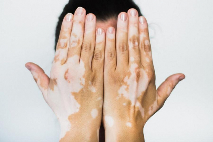 Избавление от витилиго станет возможным в ближайшее время