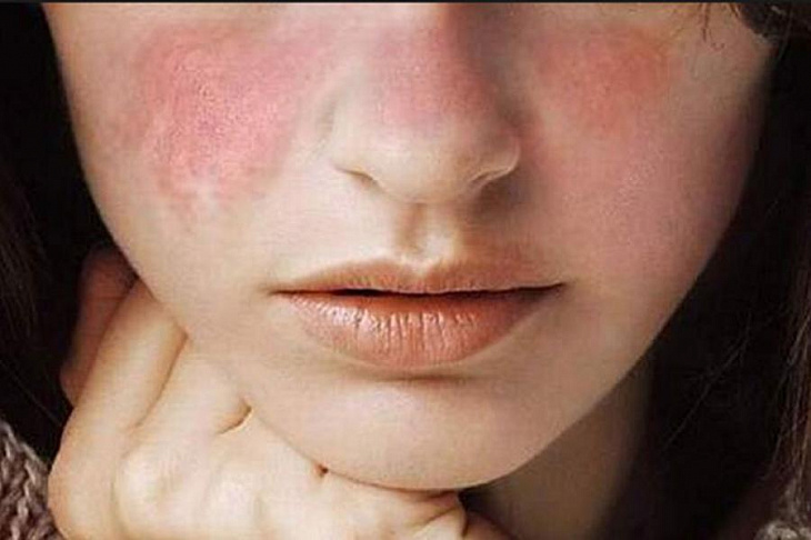 Тестирование прошло экспериментальное лекарство против волчанки